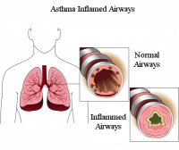 Mold Infected Airways - Mold Solutions NW